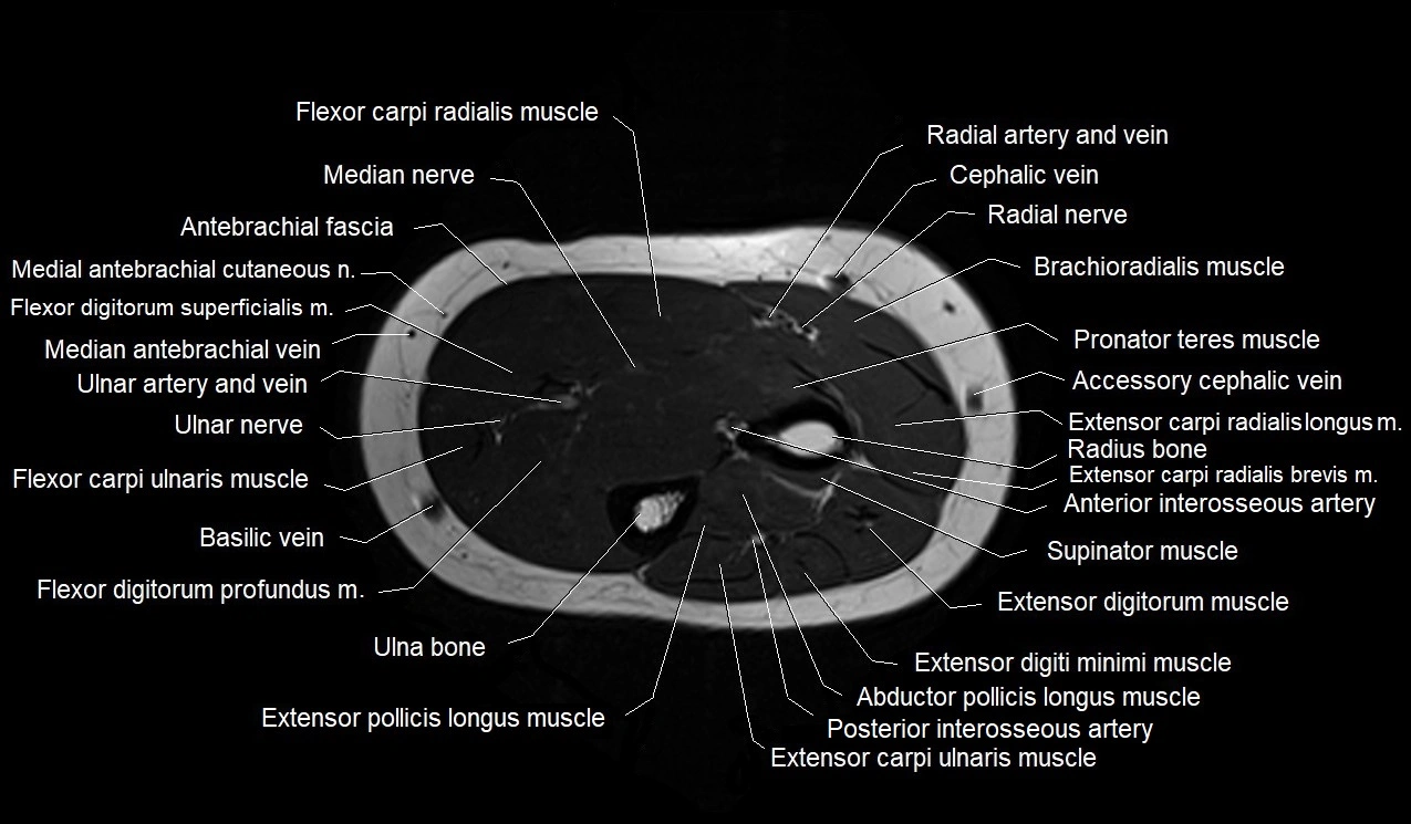 MRI 3T forearm axial cross sectional anatomy image 22.webp